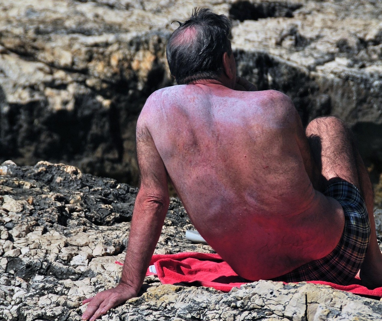 Melanomas nem sempre são fáceis de identificar
