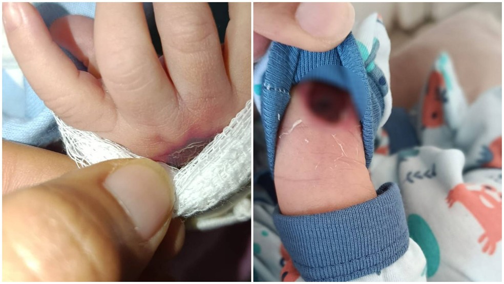 Ferimento na mão do recém-nascido na sexta-feira (15) e depois na segunda-feira (18), em Acopiara (CE) — Foto: Reprodução
