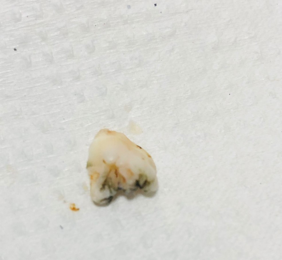Dente encontrado em marmita em Itajaí — Foto: Arquivo pessoal