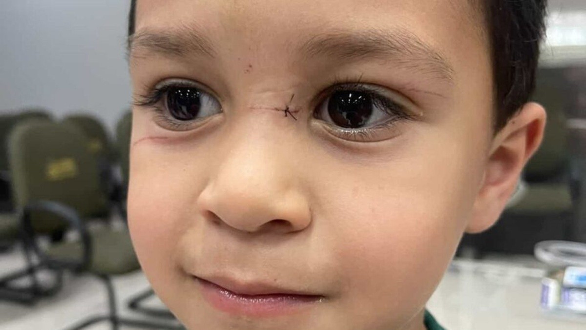 Menino de 4 anos é atingido por linha de cerol em Balneário Camboriú: 'Poderia perder a visão', diz mãe
