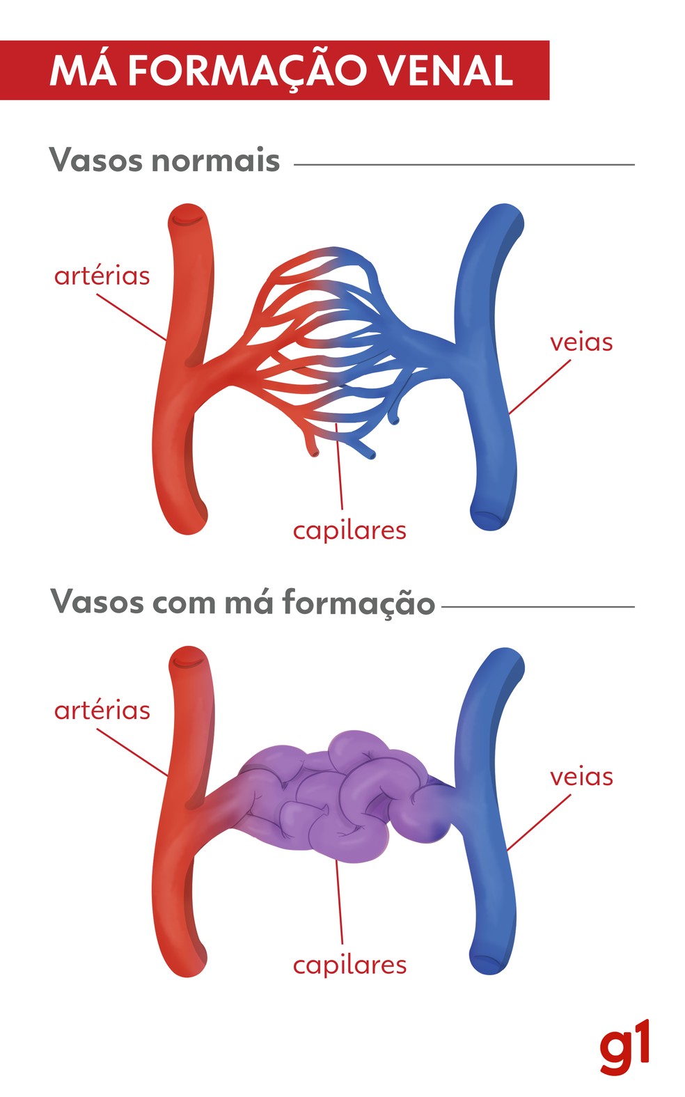 Imagem mostra como se dá a má formação venal — Foto: Artes RPC/ Gabriel Trinetto Pedrão