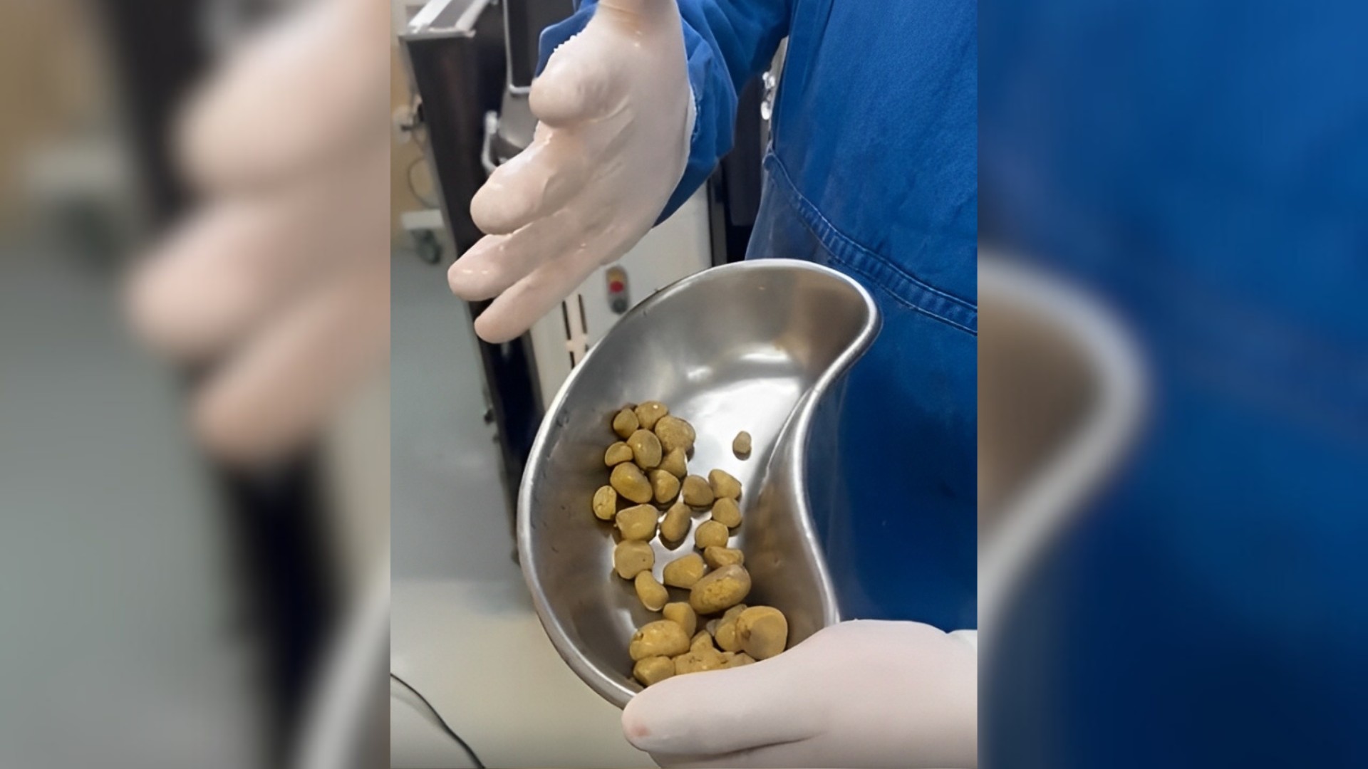 VÍDEO: Médico retira 35 pedras da bexiga de idoso em MG