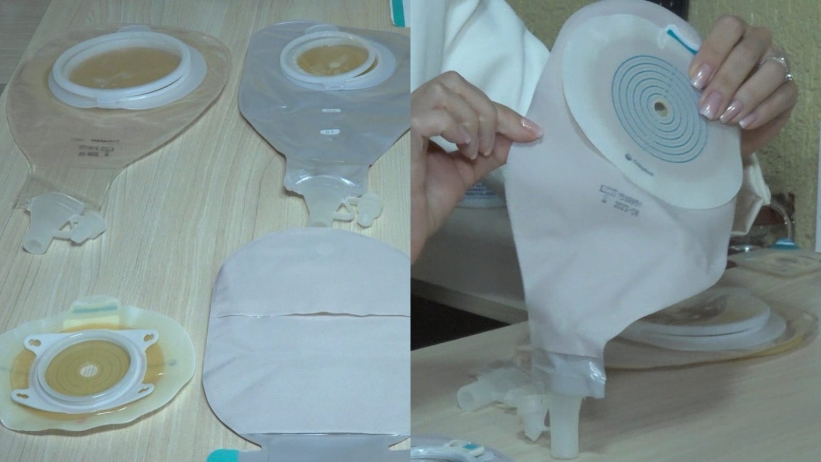 Bolsas de ostomia: pacientes da rede municipal de saúde de Teresina relatam falta de abastecimento e má qualidade dos dispositivos