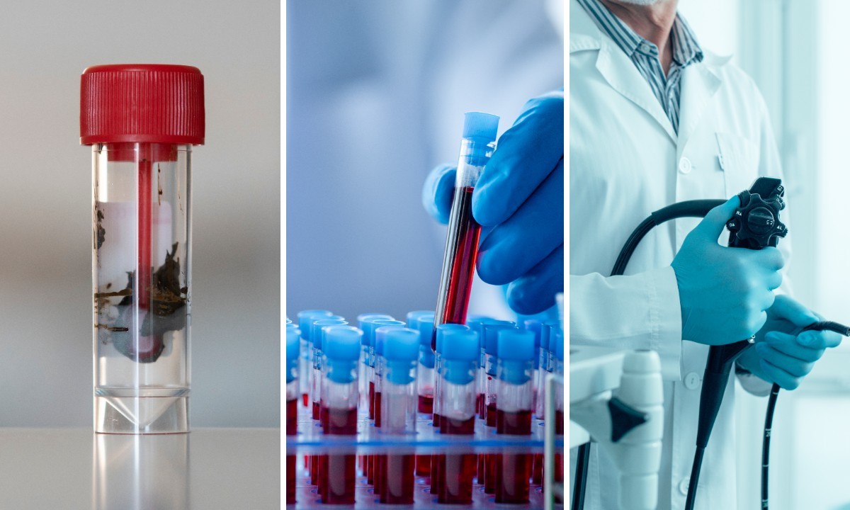 Exames de fezes e sangue se juntam à colonoscopia como opções para rastreamento de câncer colorretal