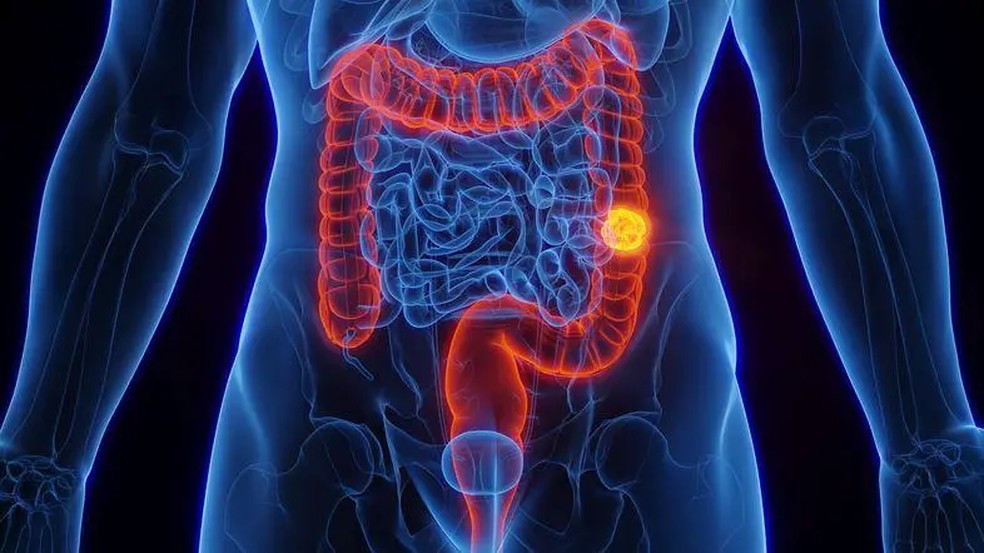 cancer de colon — Foto: GettyImages/BBC