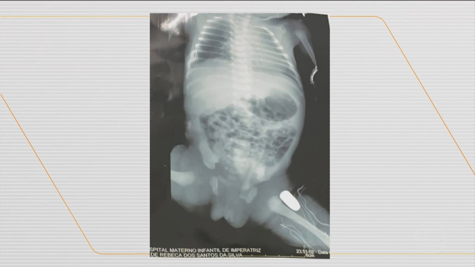 Bebê baleada dentro da barriga da mãe, no MA, passa por cirurgia para remoção do projétil 