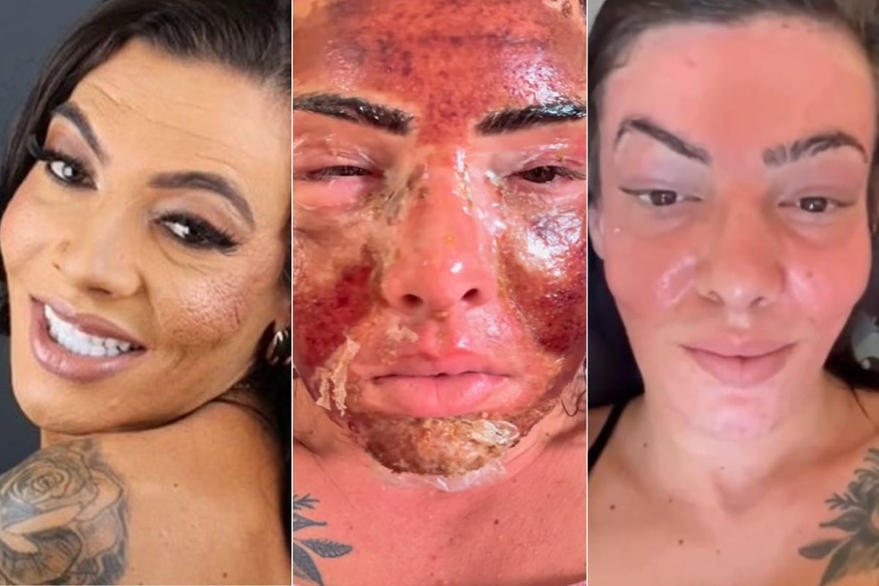 Gabrielly Miguel se submete a procedimento estético agressivo — Foto: Reprodução/Redes Sociais