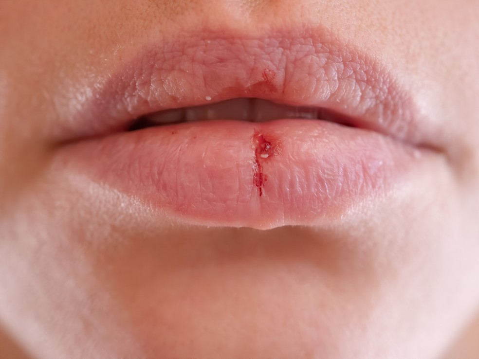 lceras, rachaduras e feridas - o que a boca pode dizer sobre sua sade  Foto: Adobe Stock