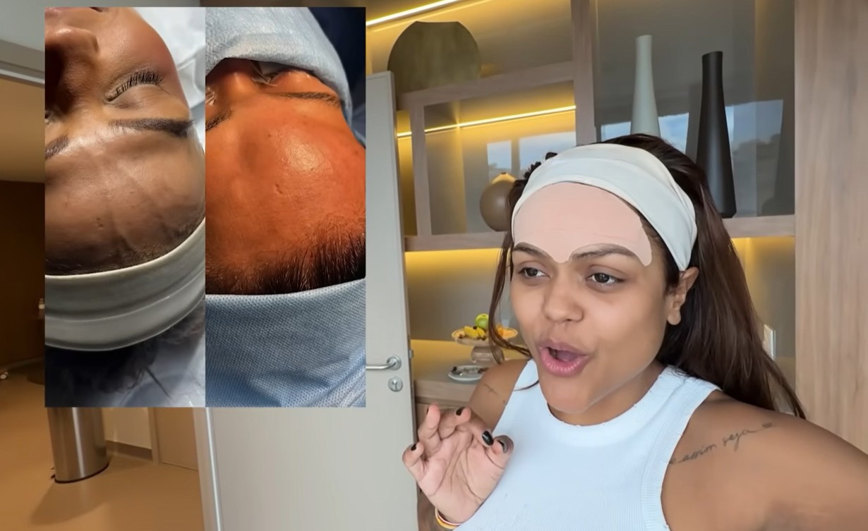 Influenciadora Camila Loures retira 'veia saltada' na testa | G1