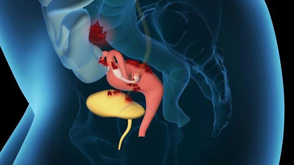 Na endometriose, o tecido que reveste o útero cresce em outras partes do corpo, como os ovários e a bexiga, como ilustrado em vermelho na imagem acima — Foto: Getty Images
