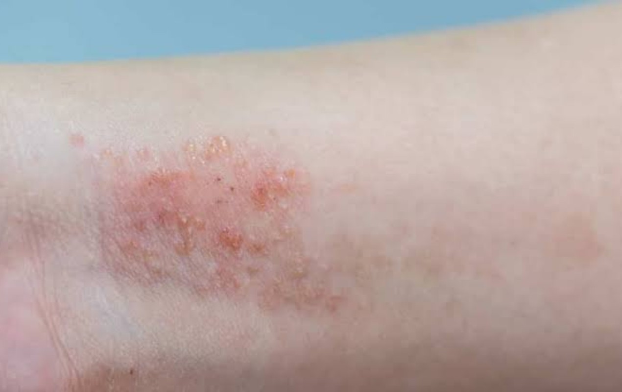 Dermatite atópica pode piorar com estresse, clima seco e produtos químicos; entenda