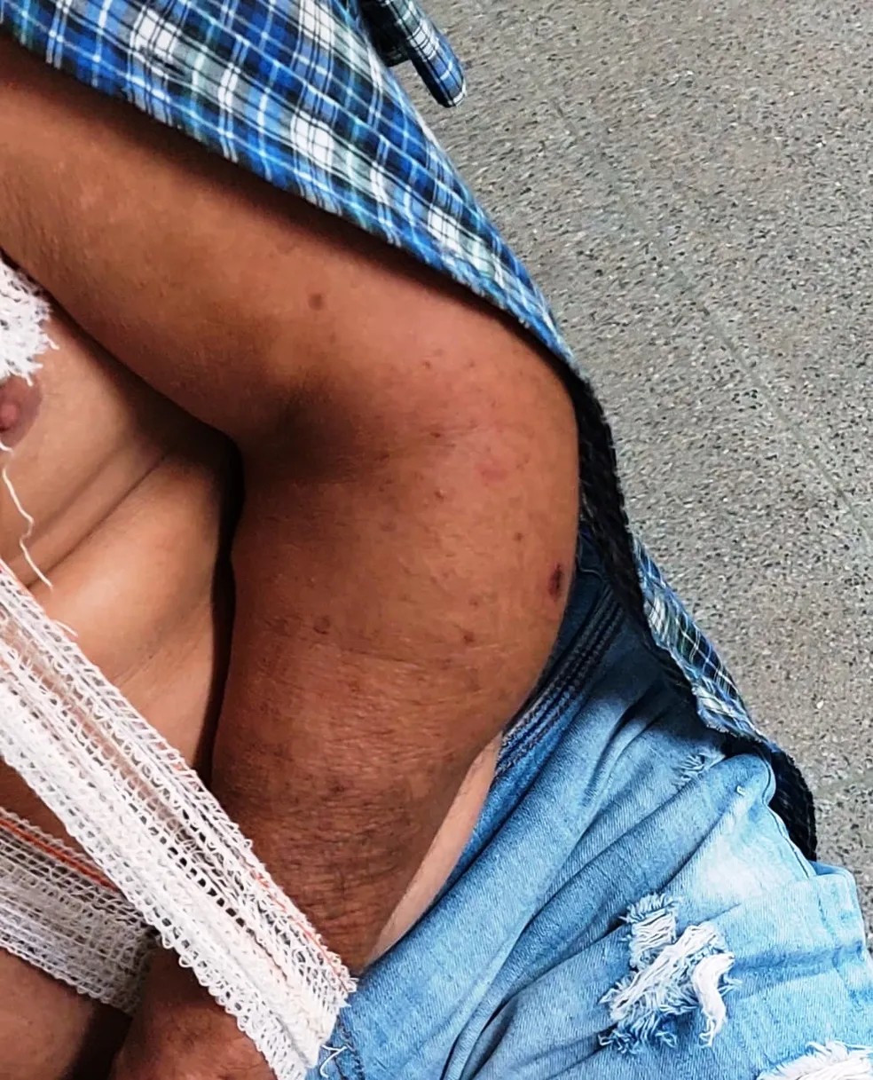 Vítima ficou com região do cotovelo inchada após agressão no trânsito — Foto: Arquivo Pessoal