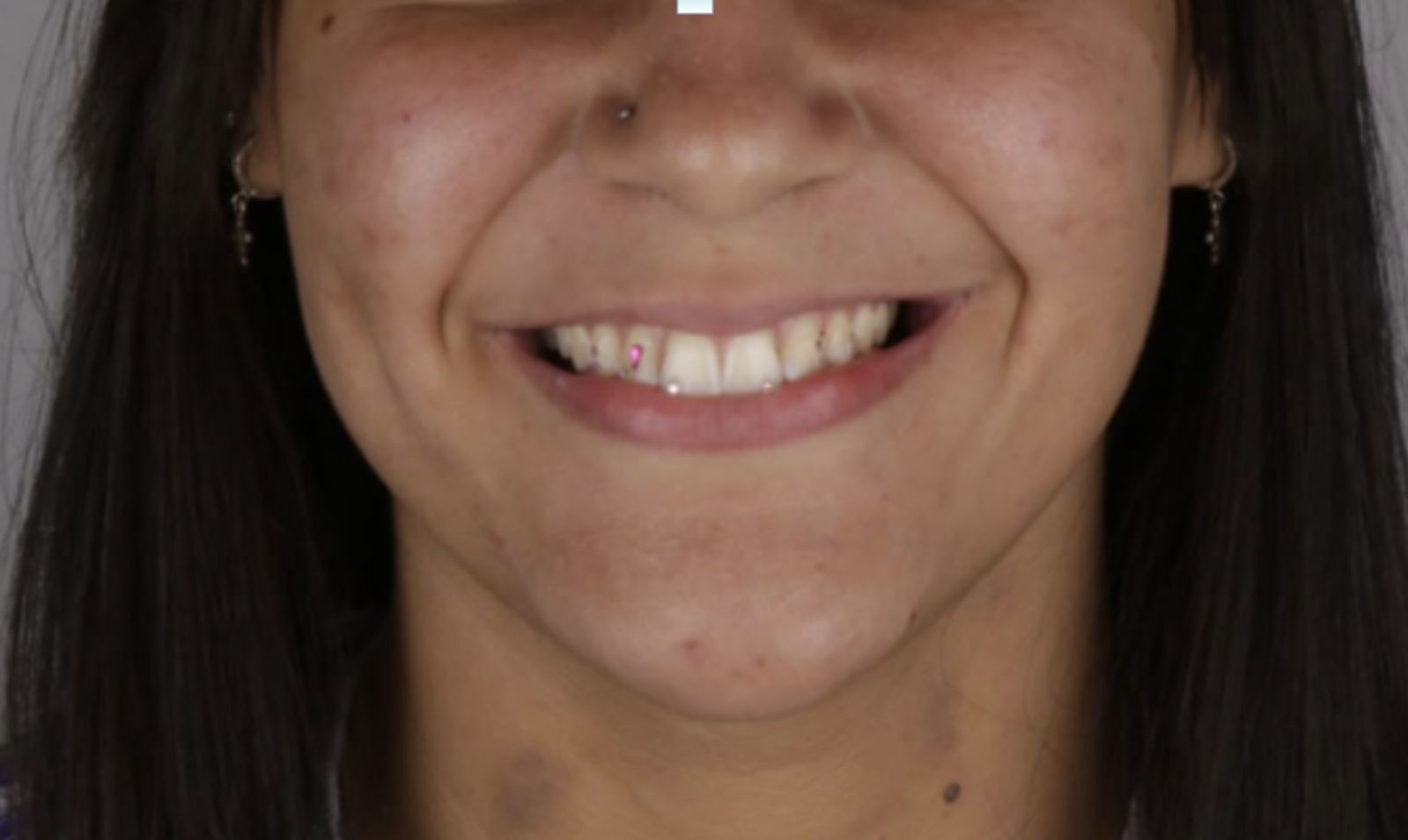 Jovem dá golpe após colocar cristais nos dentes e é presa ao ser reconhecida por dentista em parque, diz profissional