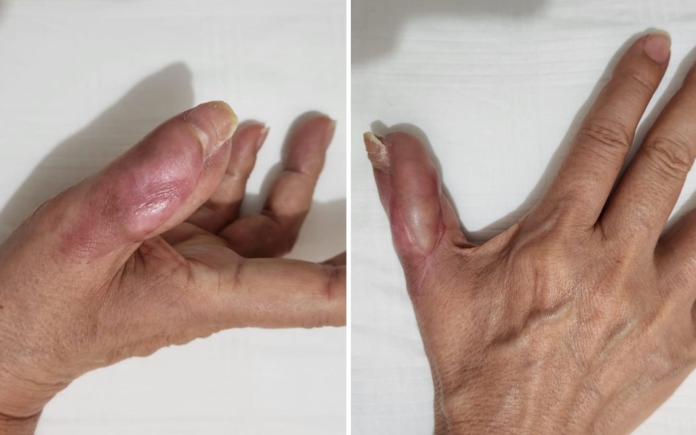 Fotos da mão de Marise Teixeira após cirurgias — Foto: Arquivo pessoal/Bruna Teixeira