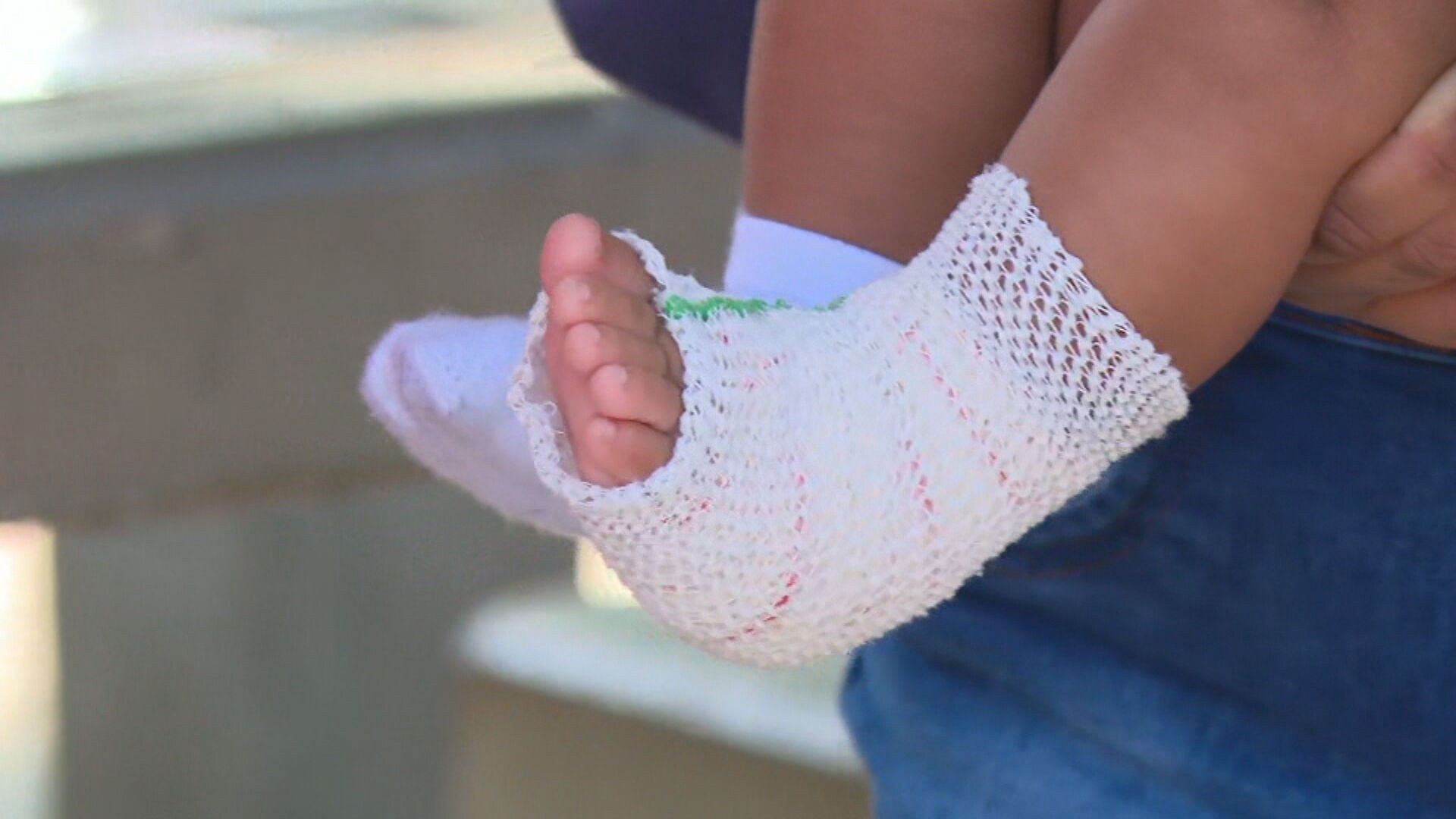 Família diz que bebê de 5 meses sofreu queimadura com compressa feita no CER do Centro