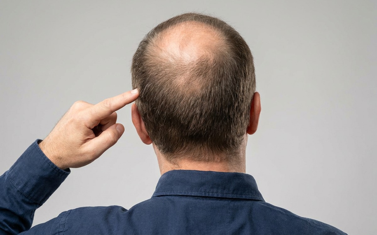 Área doadora no transplante capilar: o que é e como influencia o resultado