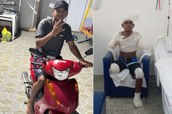 Adolescente tem braços, perna e parte de pé amputados após levar choque de alta voltagem no litoral de SP | Mais Saúde | G1