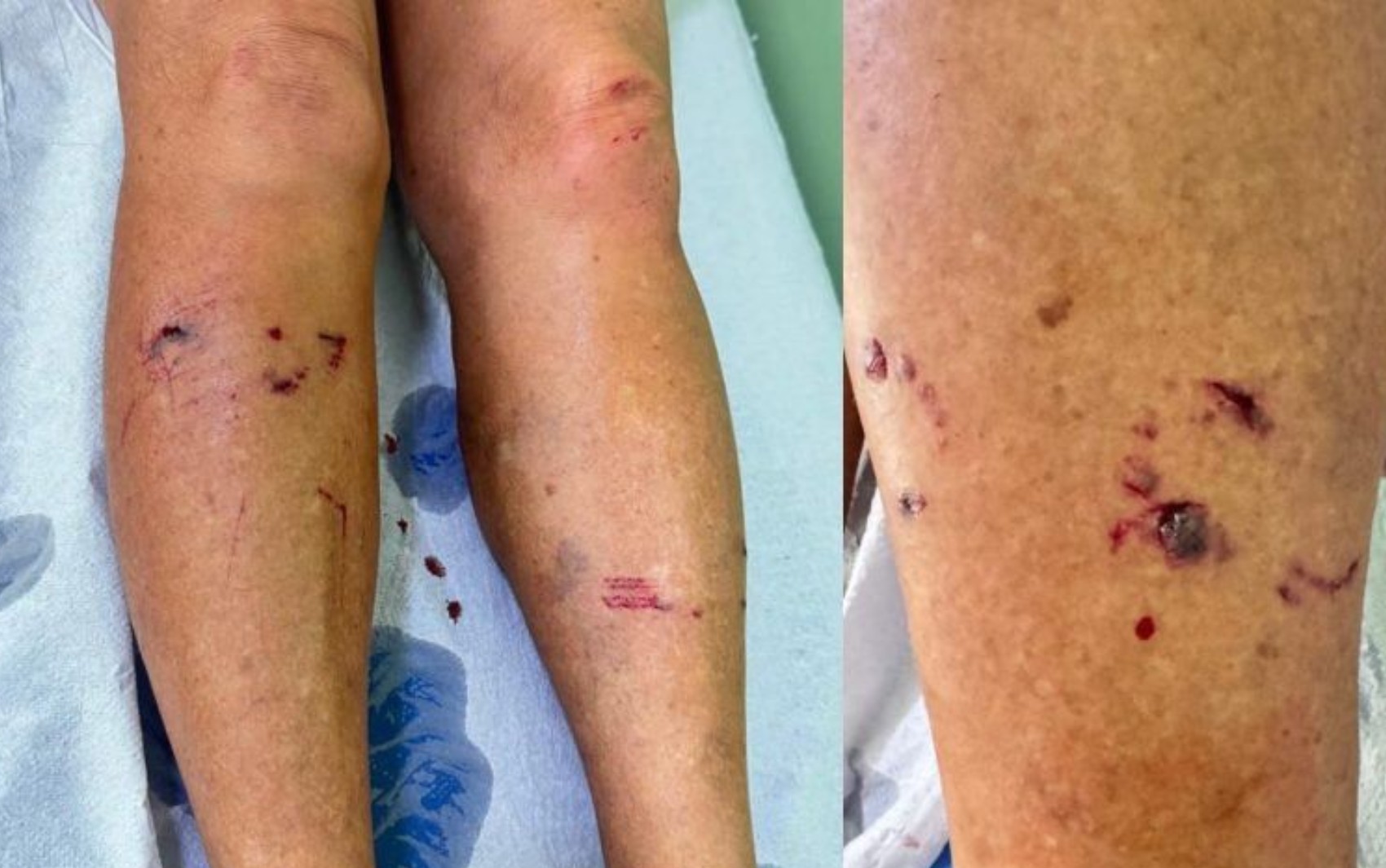 Mulher é atacada por raposa durante caminhada