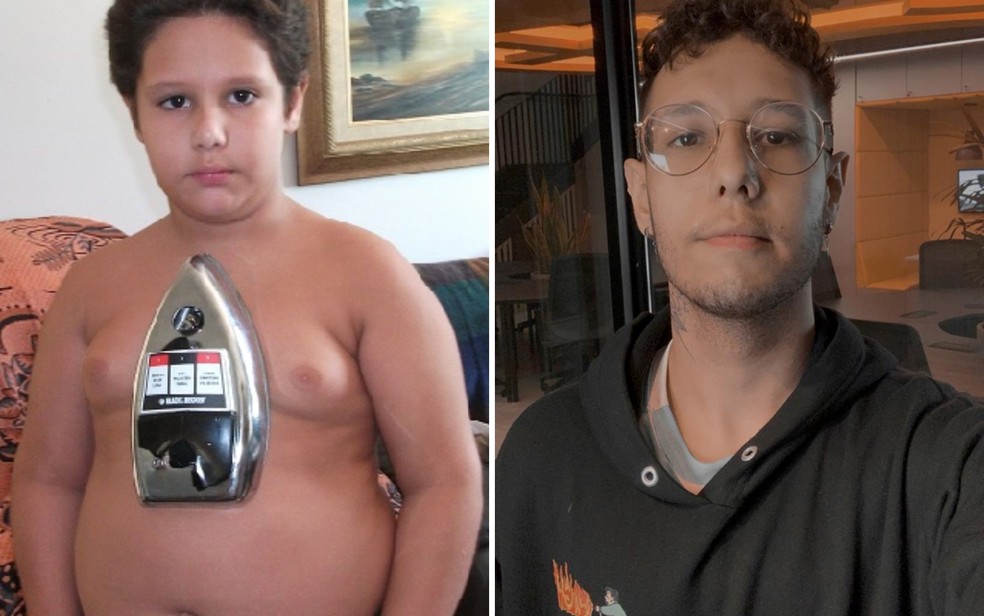 Marcos Paulo Garbone Gimenez com ferro colado ao corpo e, à direita, como está atualmente — Foto: Elisângela Nascimento/G1 GO e Arquivo pessoal/Marcos Garbone