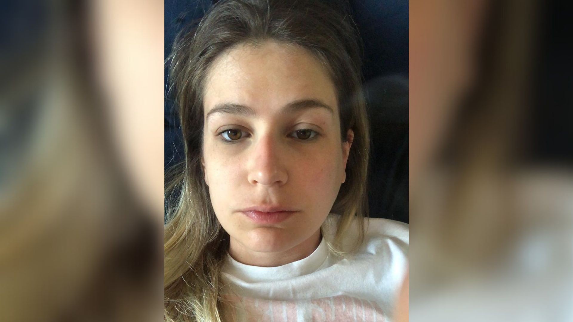 Publicitária descobre Síndrome de Sjögren dez anos após ter inchaço no rosto e dificuldade para comer: 'Susto'