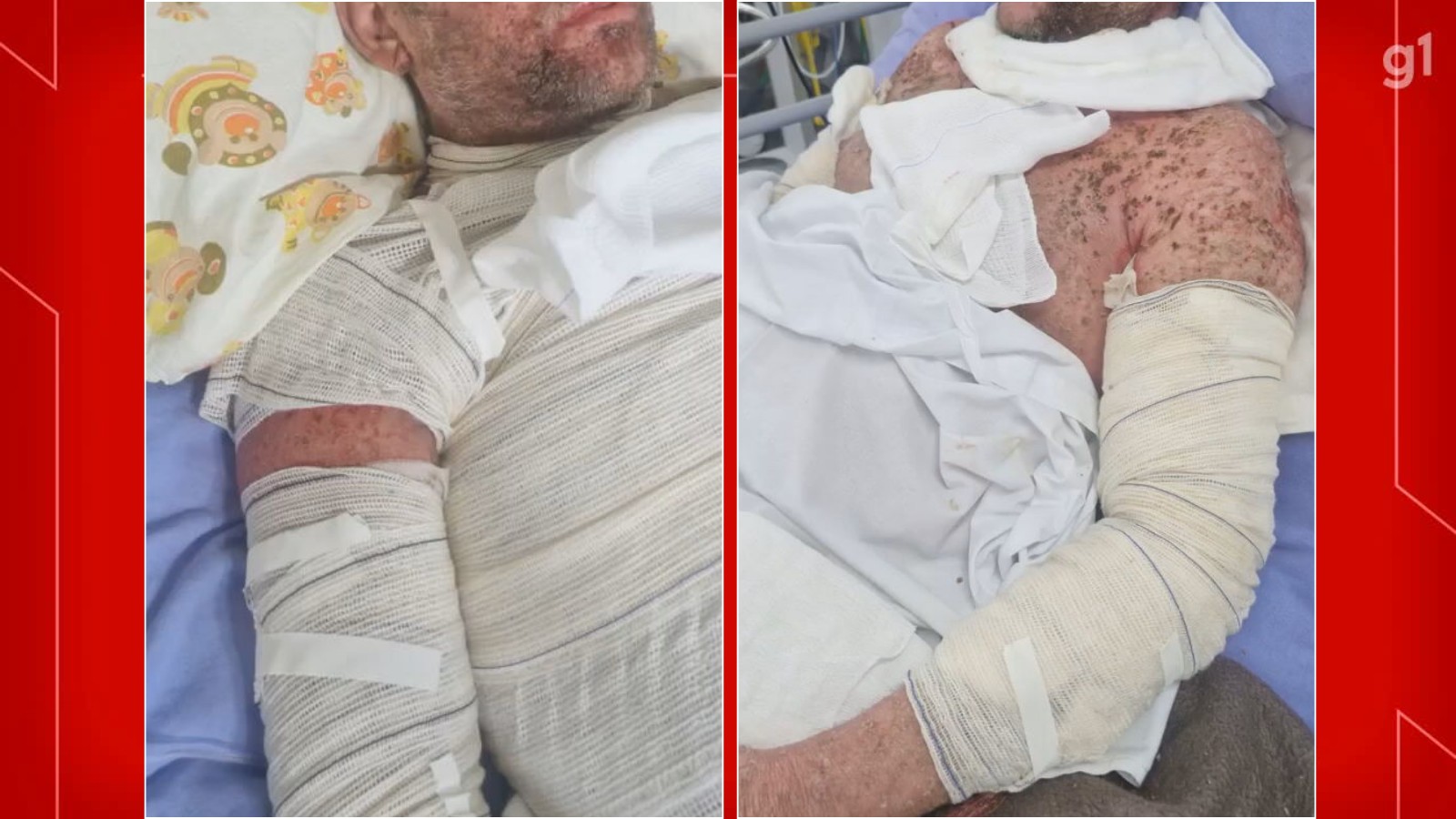 Morador do DF descobre síndrome rara e passa 80 dias em semi-UTI durante tratamento contra câncer