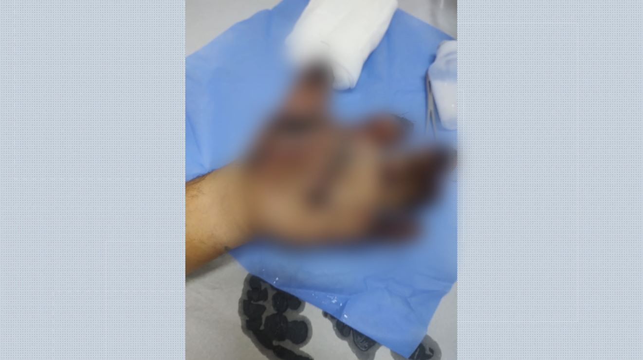 Pintor perde dedos da mão após bomba explodir durante trabalho na casa de ex-policial em Barretos