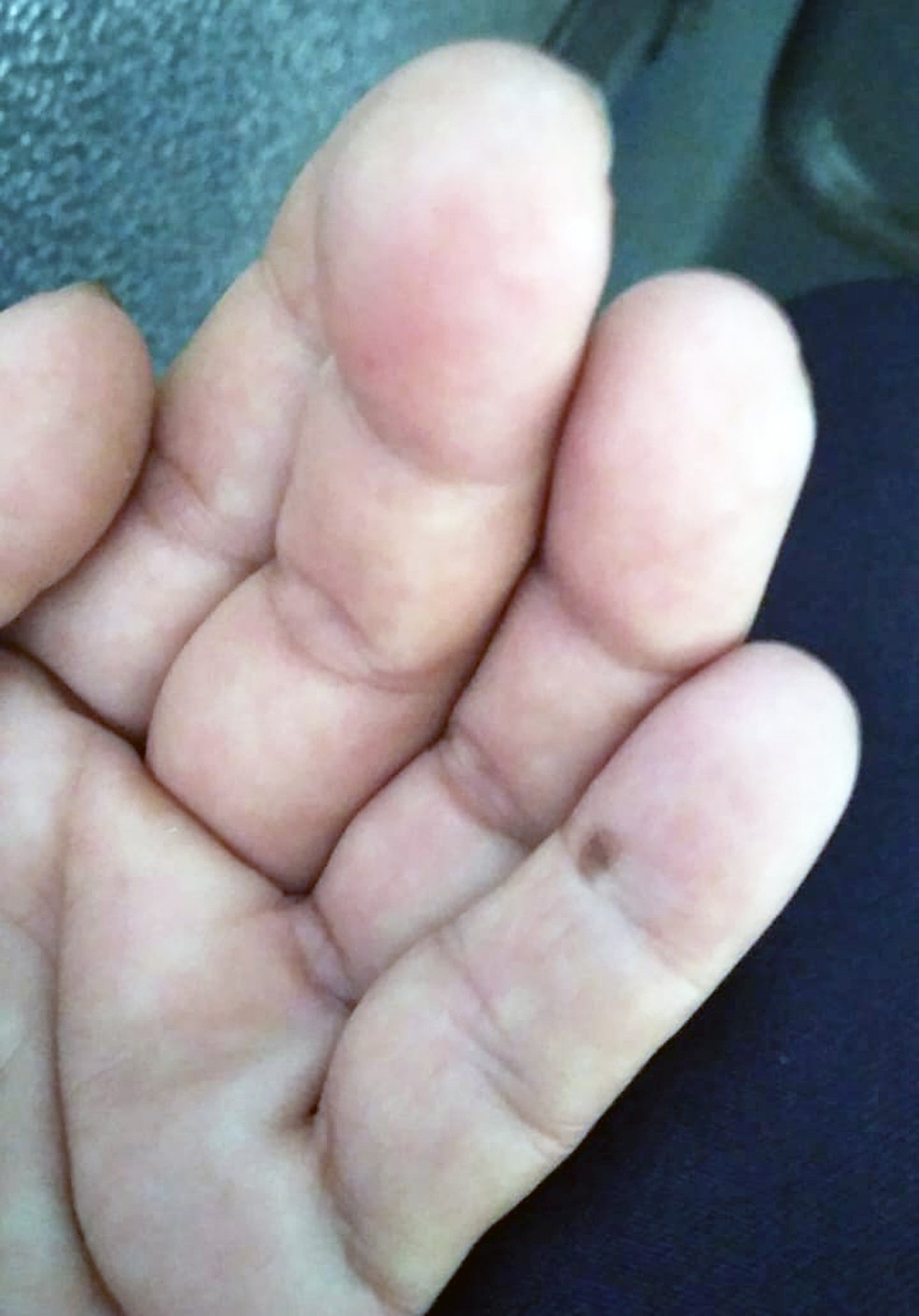 Mão que foi picada pelo escorpião — Foto: Acervo pessoal
