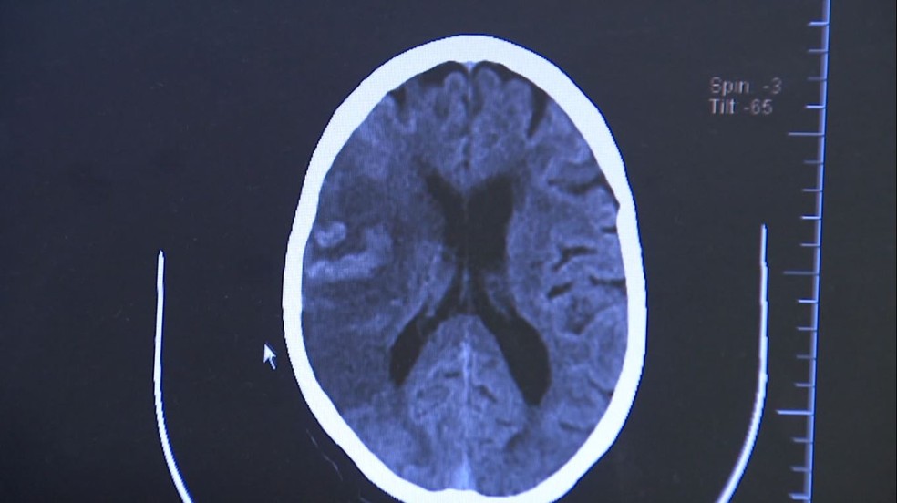 Durante o AVC isquêmico há um bloqueio na artéria, levando à falta de sangue e morte das células cerebrais. Já no hemorrágico, o sangue extravasa por ruptura de um vaso — Foto: Reprodução EPTV