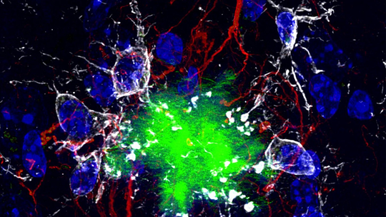 Em feito inédito, cientistas aceleram amadurecimento de 'minicérebros' humanos em estudo sobre Alzheimer; entenda - Organoides cultivados em laboratório amadureceram de forma mais rápida e conseguiram enviar comandos a um robô. Técnica pode acelerar pesquisas sobre a doença, mas ainda está restrita a testes em laboratório, sem aplicação imediata em pacientes.