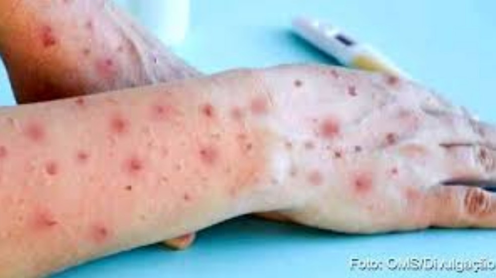 Fique atento aos sintomas da MPOX: febre, dor de cabeça, dores musculares, gânglios inchados e lesões na pele. Em caso de suspeita, procure a unidade básica de saúde mais próxima. A prevenção começa pela informação — Foto: OMS