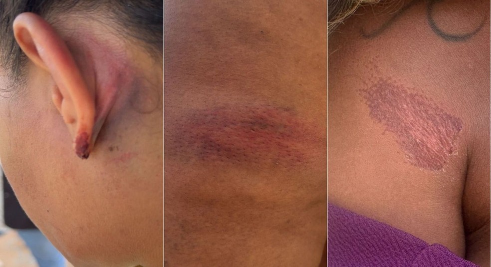 Advogada mostra marcas no corpo após denunciar agressão de policiais militares em festa no RN — Foto: Iara Nóbrega/Inter TV Costa Branca