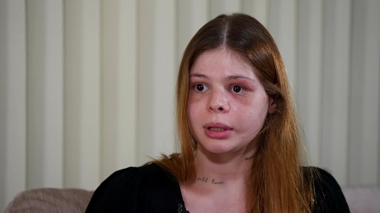 Médica que teve rosto desfigurado pelo namorado fala sobre ataque que sofreu no dia em que fez aniversário