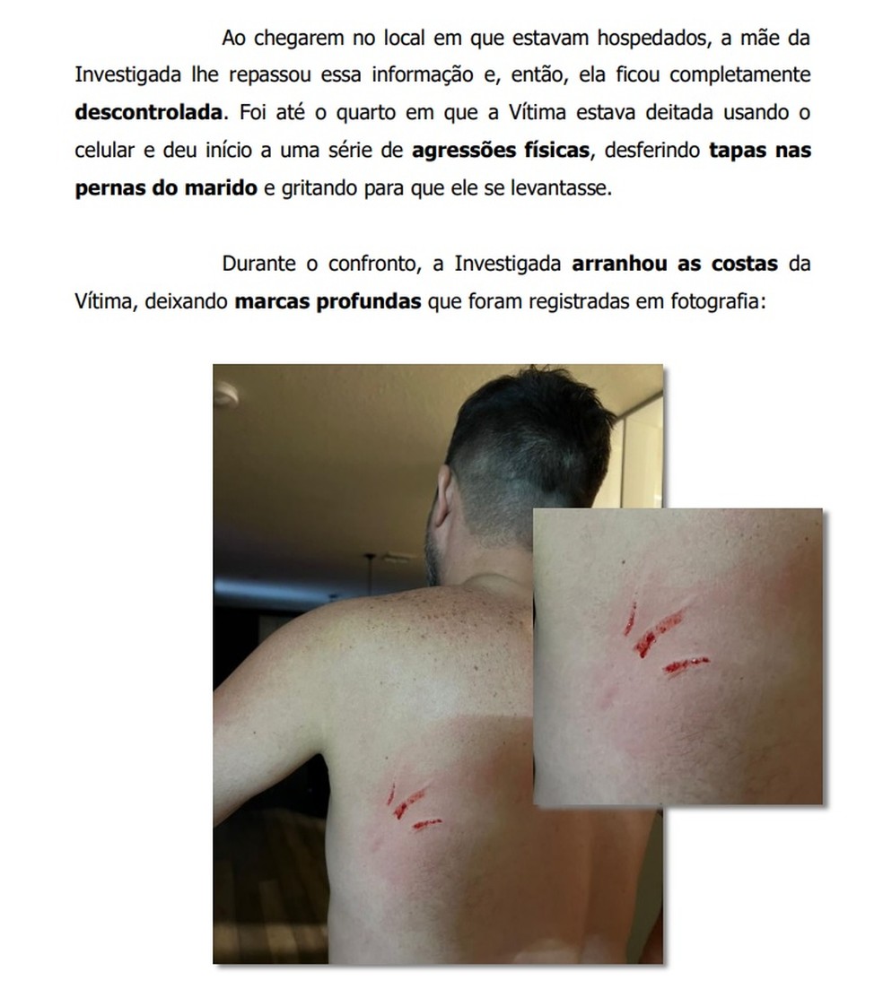 Hematomas nas costas de Erwin Goering, supostamente causados em briga dele com a esposa, em Orlando, nos Estados Unidos. — Foto: Reprodução