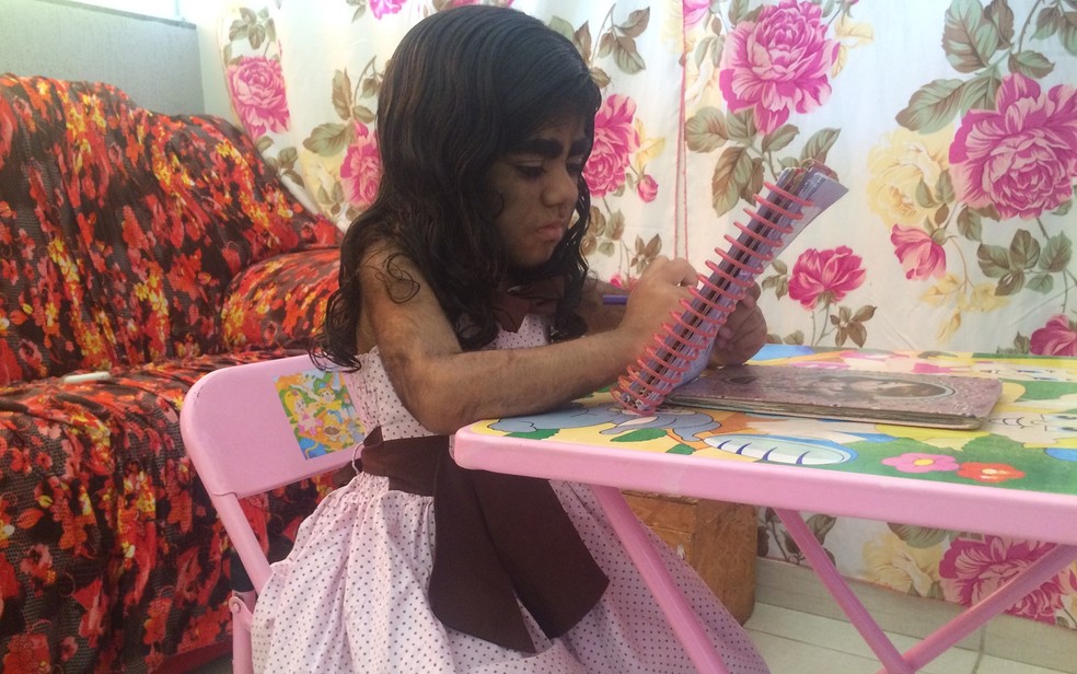 Kemilly Vitória Pereira de Souza, 5, tem uma doença genética e nasceu com corpo coberto de pelos — Foto: Fernanda Borges/G1