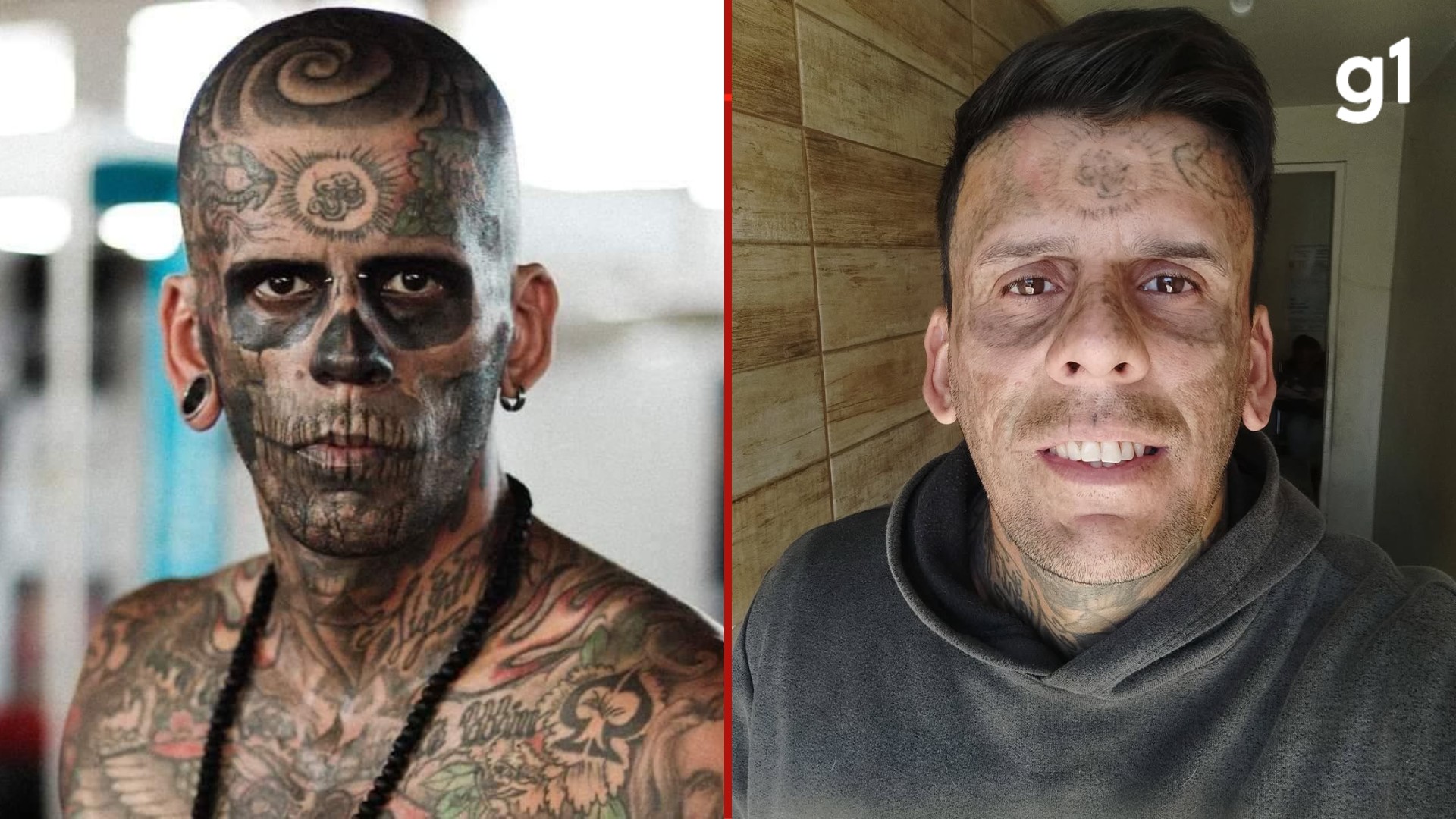 Lembra dele? 'Mais tatuado do Brasil' passa por 4ª sessão de remoção de tatuagens no rosto e compartilha resultados