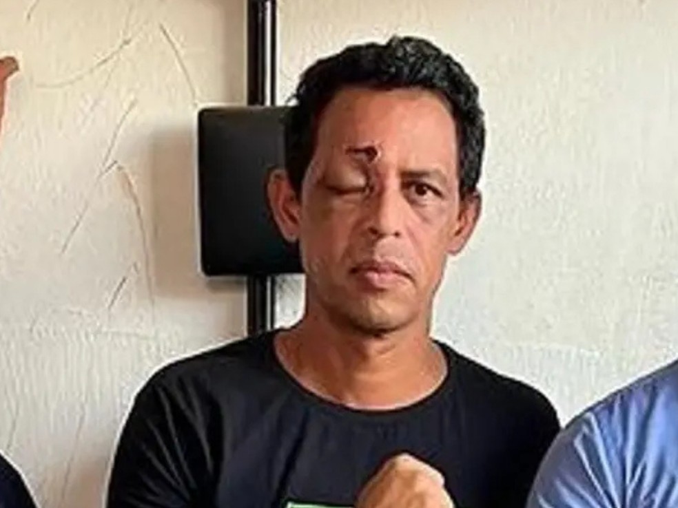 Policial penal atingido por estilhaços de bala precisa de novo tratamento — Foto: Arquivo pessoal