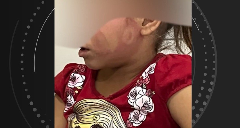 Justiça converte em preventiva a prisão de pai que agrediu filha com sandália no rosto em Alagoas