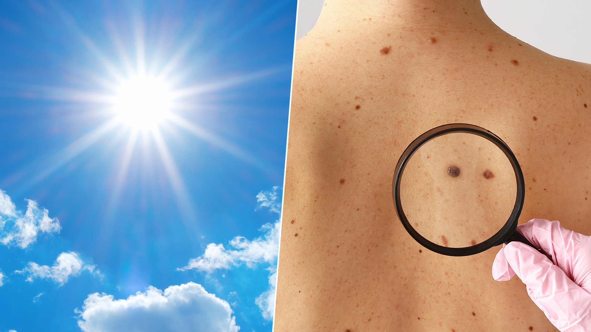 Raios UV causam 80% dos melanomas no mundo, segundo agência da OMS
