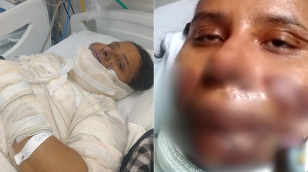 Mulher se queima ao fritar ovo e morre 10 dias depois no interior de SP; imagens fortes | São Carlos e Araraquara | G1