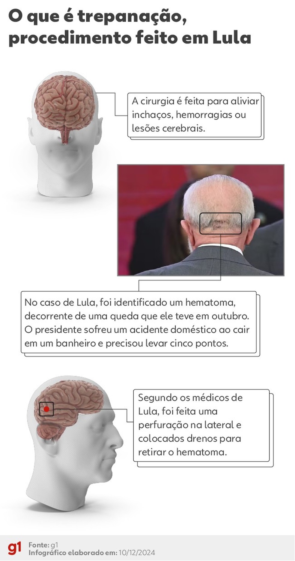 Veja como é procedimento feito em Lula — Foto: Arte/g1