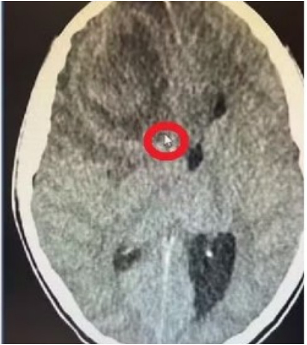 Millena Brandão tinha 11 anos; exame onde círculo vermelho mostra mancha suspeita de ser um tumor no cérebro da atriz, segundo a família — Foto: Reprodução