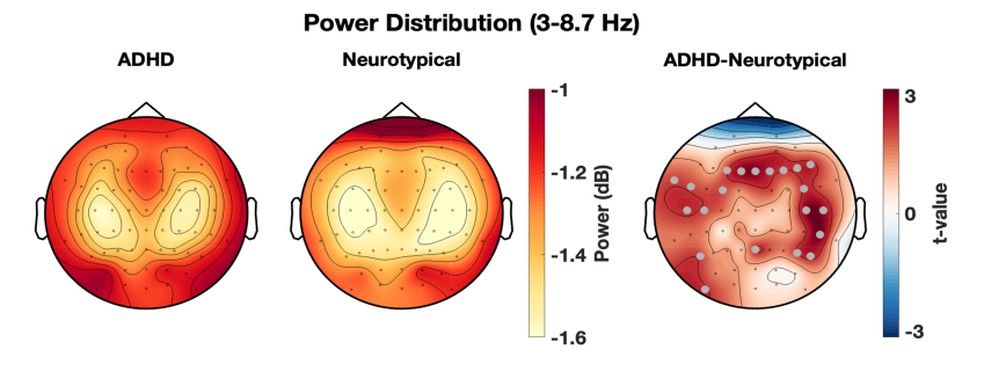 Mapa cerebral mostra maior atividade semelhante ao sono em adultos com TDAH durante tarefa de atenção. — Foto: Pinggal et al., 2026
