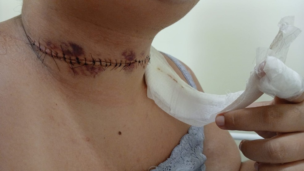 Jovem leva 25 pontos no pesco&ccedil;o ap&oacute;s linha com cerol ficar a um mil&iacute;metro  da veia jugular: 'Milagre' | S&atilde;o Carlos e Araraquara | G1