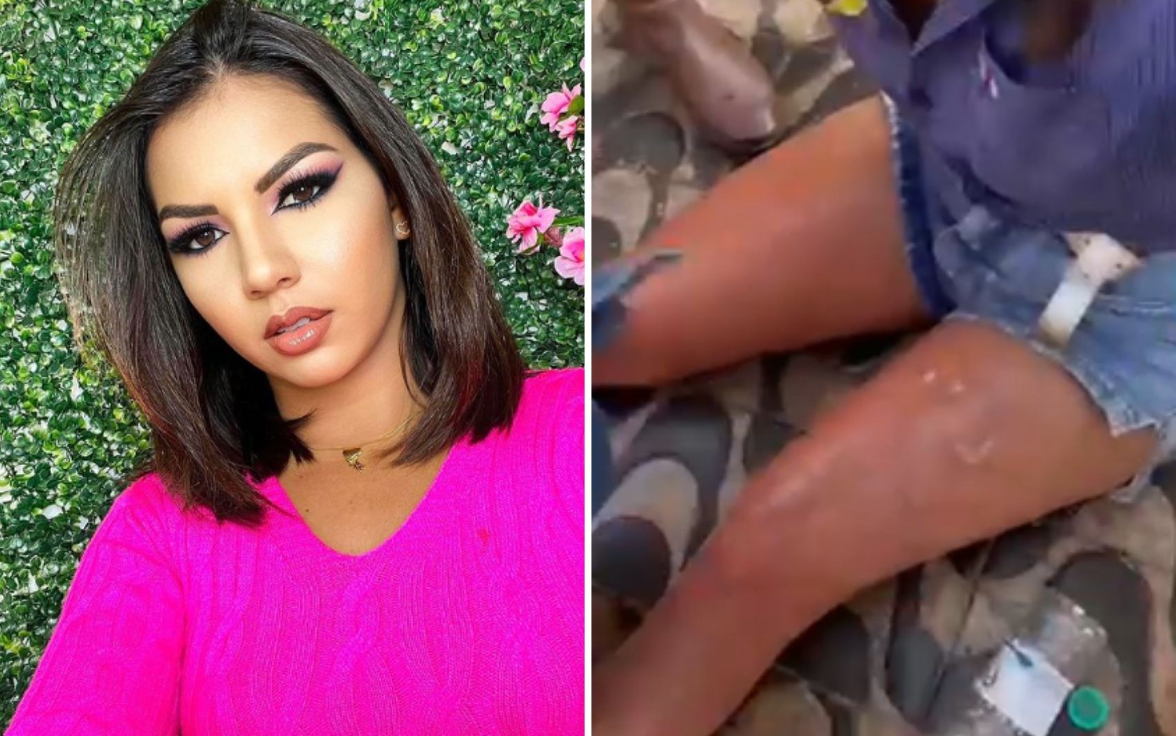 Influencer tem graves queimaduras nas pernas após mulher acender churrasqueira com álcool e fogo atingi-la; vídeo