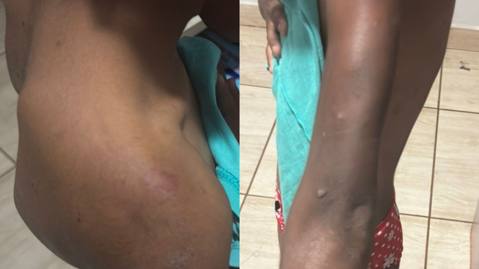 Casal preso suspeito de torturar sobrinha por um ano deixou vítima com lesões aparentes: 'Diversos estágios de cicatrização', diz delegado