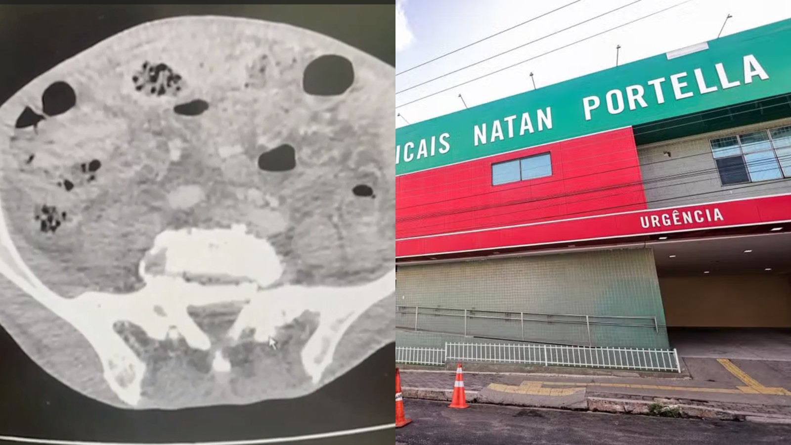 Mulher recebe laudo sobre próstata e MP apura denúncia sobre uso de telemedicina no Piauí