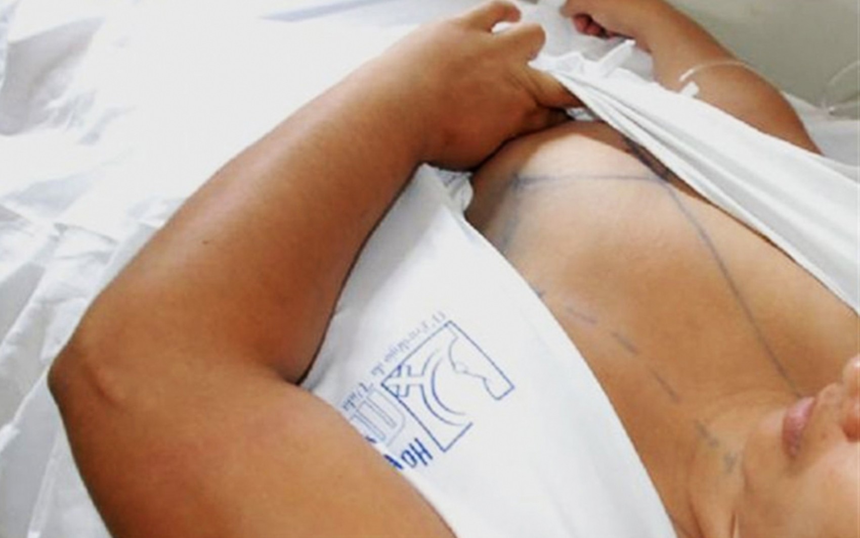 Fundação divulga aprovadas para cirurgia de mamas na Bahia