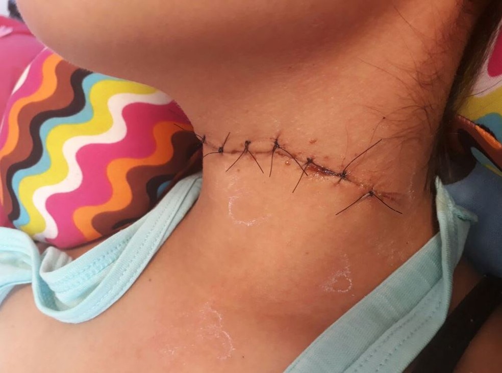 Motociclista tem pesco&ccedil;o cortado por linha com cerol em Itapetininga |  Itapetininga e Regi&atilde;o | G1