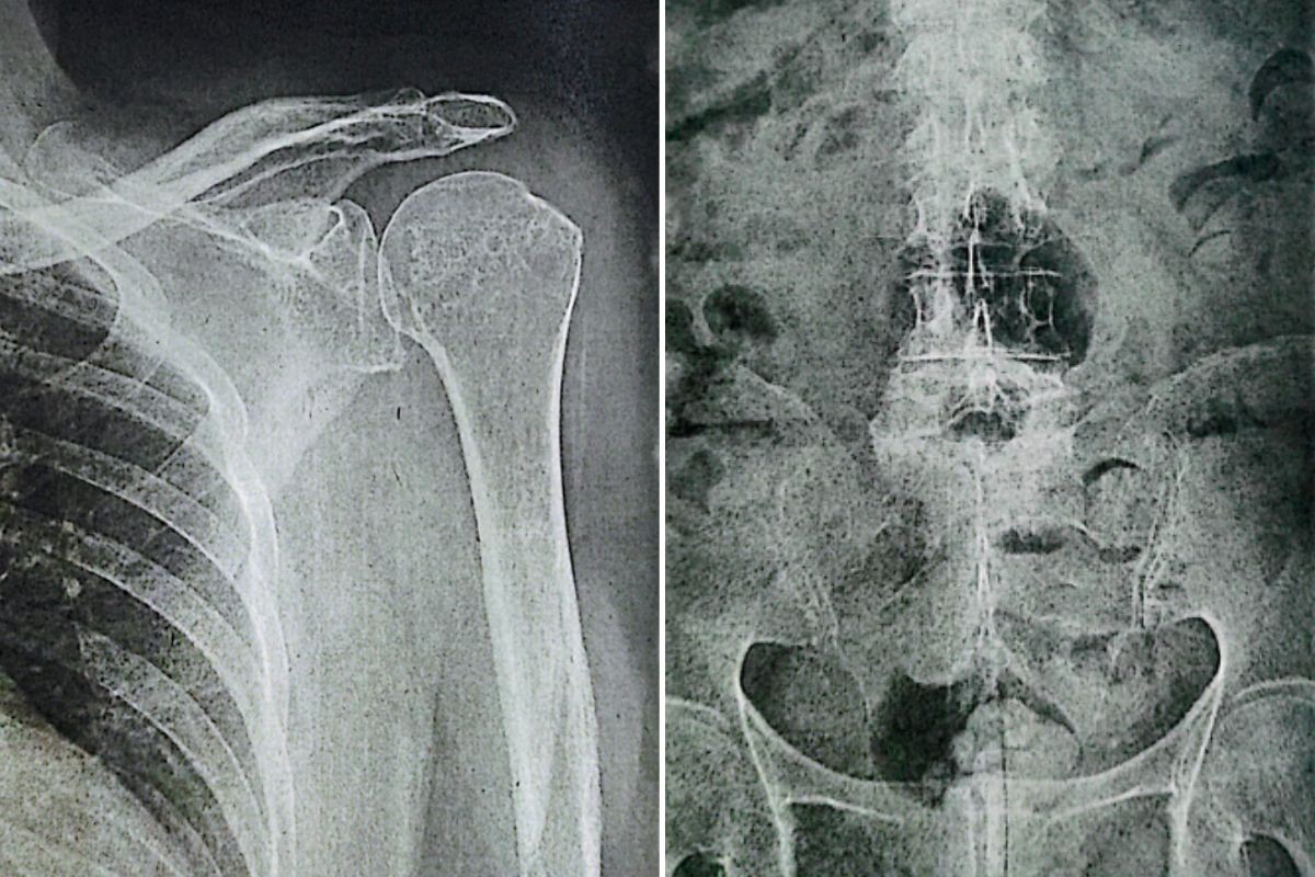 Mercado é condenado a pagar R$ 20 mil a idosa que sofreu lesões após escorregar em poça de detergente 