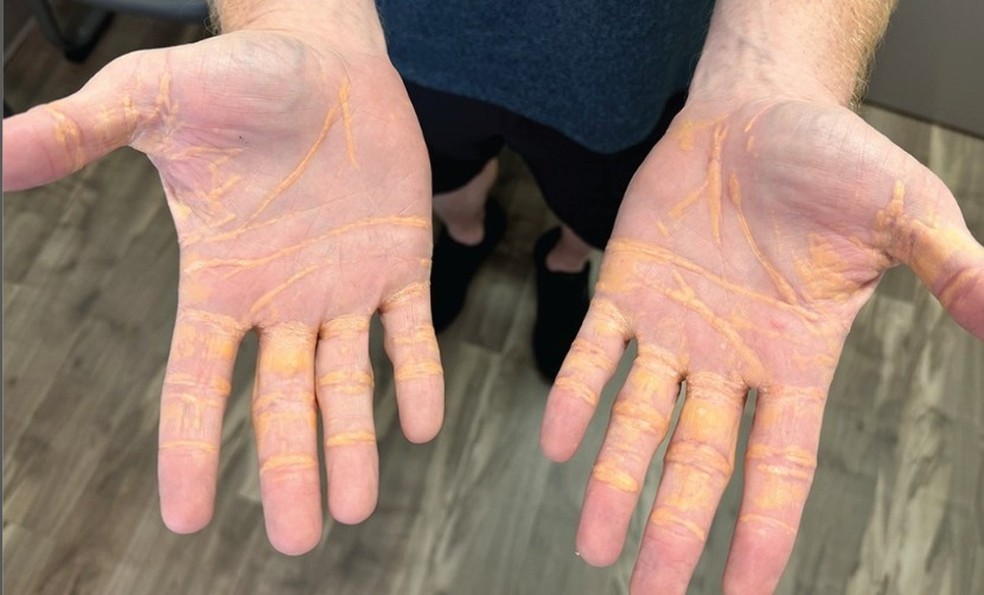 Nódulos só podem ser retirados com cirurgia — Foto: Divulgação/JAMA